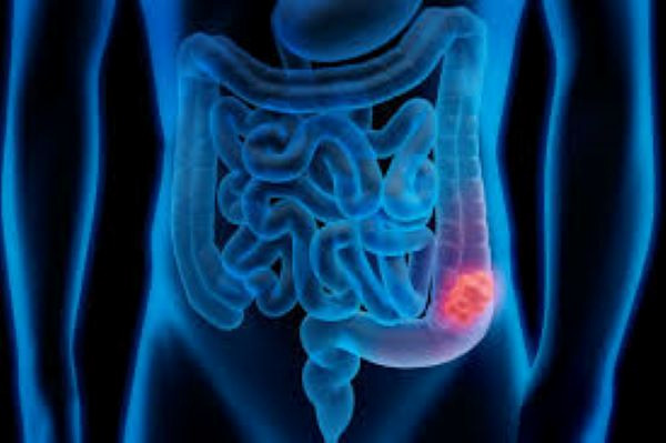  سرطان های شایع